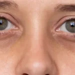 10 Huismiddeltjes Om Donkere Wallen Onder Je Ogen Weg Te Houden!