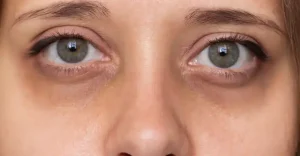 10 Huismiddeltjes Om Donkere Wallen Onder Je Ogen Weg Te Houden!